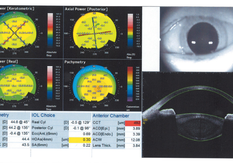 CASIA2で計測した前眼部OCT像と、角膜全面・後面データ